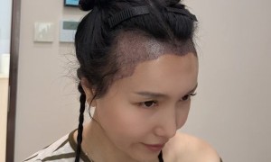 2026年植发服务趋势洞察：技术、团队与合同保障的协同构建