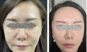 面部抗衰手术从单一拉皮到多层次复位的理念变迁与机构实践